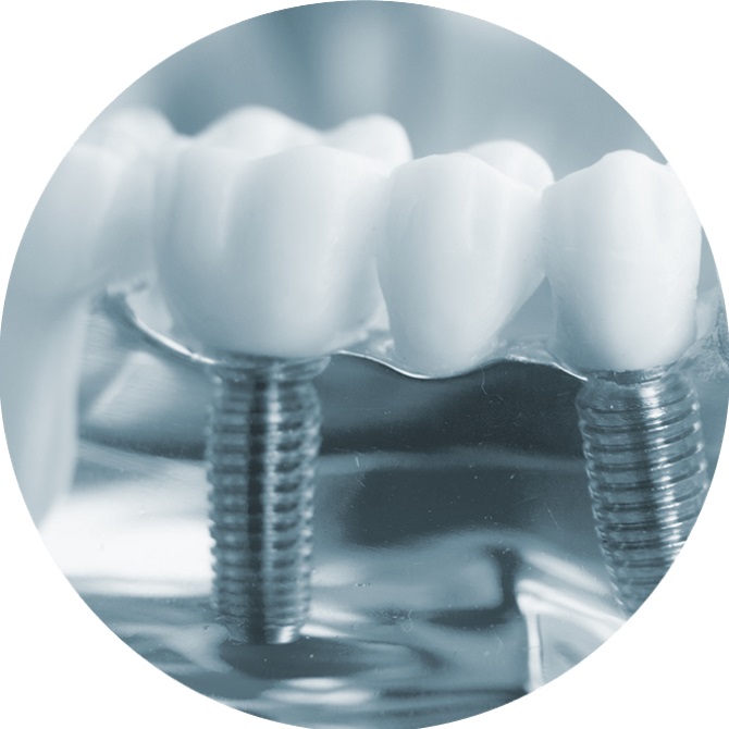 implantdental implantdental